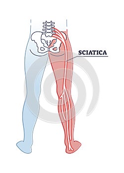 Sciatica pain or nerve weakness as leg lumbar radiculopathy outline diagram photo