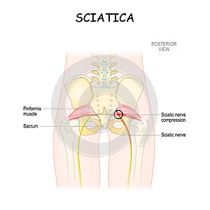 Sciatica. piriformis syndrome