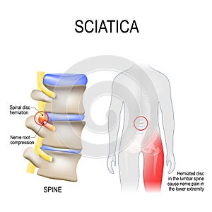 Sciatica. scheme with vertebrae, disks and nerves. Human body from back