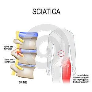 Sciatica. scheme with vertebrae, disks and nerves. Human body from back photo