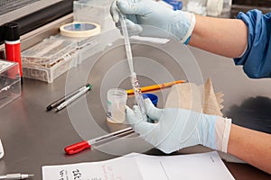 Scientist preparing a peritoneal fluid sample for cytology analysis in the laboratory. Cancer diagnosis concept. Medical concept