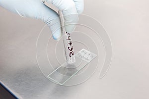 Scientist preparing a peritoneal fluid sample for cytology analysis in the laboratory. Cancer diagnosis concept. Medical concept