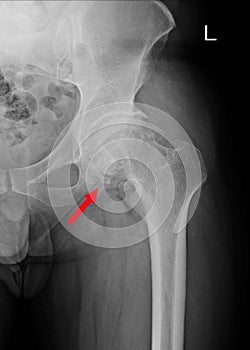 Sclerosis of articular surface of acetabular with marginal osteophytes. Osteoma at superior and inferior margins of femoral head.