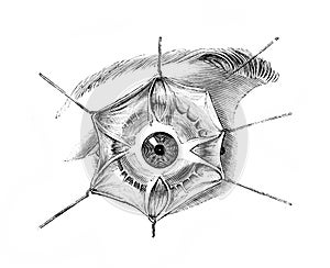 Sclerotic insertion of the right muscles in the old book D`Anatomie Chirurgicale, by B. Anger, 1869, Paris