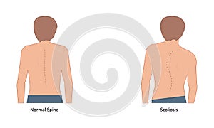 scoliosis vector illustration