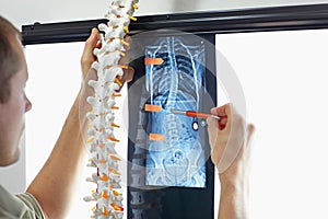 Scoliosis.Diagnosis,treatment planning. Doctor with model of spine watching image of chest at x-ray film viewer. photo