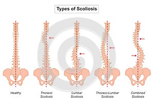 Scoliosis is a condition characterized by an abnormal curvature of the spine photo
