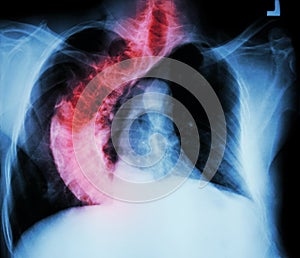 Scoliosis ( crooked spine ) X-ray chest of old people with croo