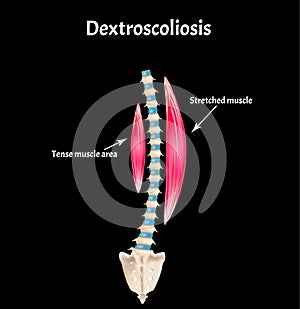 Scoliosis Dextroscoliosis. Spinal curvature, kyphosis, lordosis, scoliosis, arthrosis. Infographics. Vector illustration