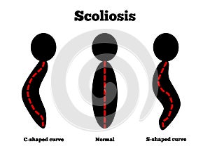 Scoliosi 