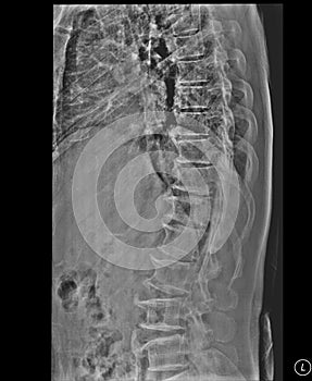 Scoliosis film x-ray lumbar spine