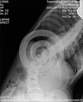 Scoliosis film x-ray show spinal bend in teenager patient