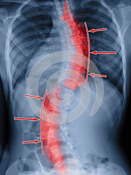 Scoliosis film x-ray spinal bend. Treatment concept