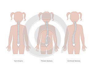 Scoliosis flat vector illustration