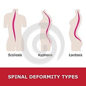 Scoliosis, lordosis and kyphosis