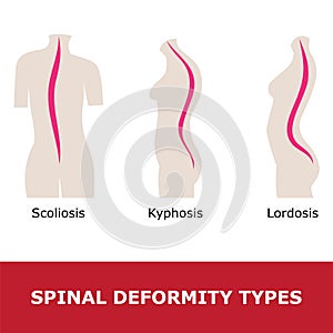 Scoliosis, lordosis and kyphosis photo