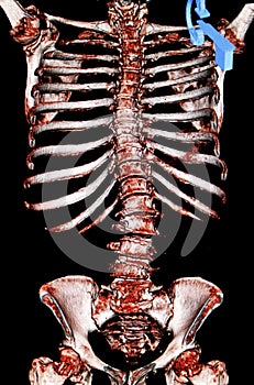 Scoliosis. Osteoporosis. CT-scan reconstruction photo
