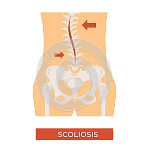 Scoliosis spine curvature skeleton bone disease vector illustration