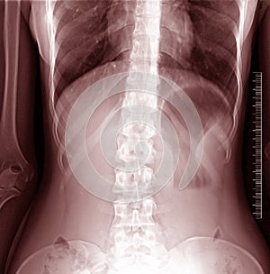 Scoliosis x-ray photo