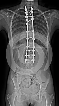Scoliosis X-ray photo