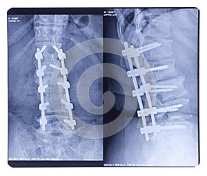Scoliosis, X-ray photo