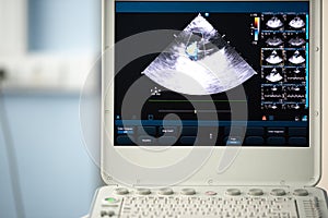 A screen of an ultrasound device with a heart scan and tricuspid regurgitation shown.