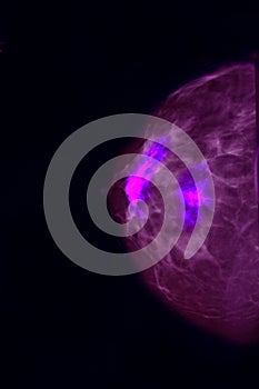 Proyección senos cáncer 
