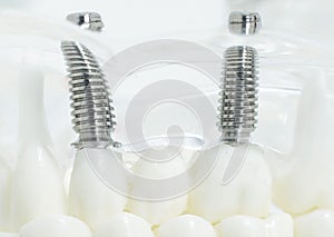 Screwed dental implants in the jaw. Concept of modern procedure in dentistry, dental implants, background