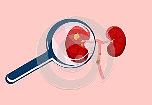 Scrutiny Kidney stone with magnifying glass.Nephrology.Pyelonephritis and renal failure disease.