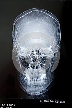 Scull x-ray