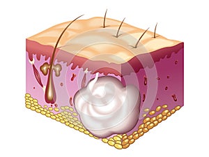 Sebaceous cyst