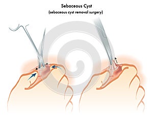 Sebaceous cyst photo