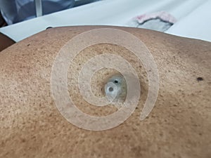 SEBACEOUS cyst with punctum on the abdominal wall skin