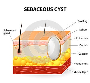 Sebaceous cyst or trichilemmal cyst