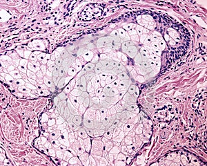 Sebaceous gland photo