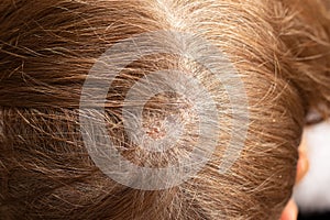 Seborrhea dermatitis condition on female`s scalp, a close up