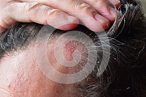 Seborrhea dermatitis hair dandruff