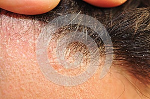 Seborrhea seborrheic dermatitis photo