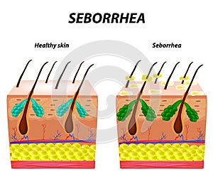 Seborrhea skin and hair. Dandruff seborrheic dermatitis. Eczema. Dysfunction of the sebaceous glands. Inflammatory skin disease.