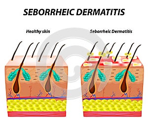 Seborrhea skin and hair. Dandruff seborrheic dermatitis. Eczema. Dysfunction of the sebaceous glands. Inflammatory skin