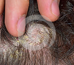 Seborrhea symptom in scalp photo