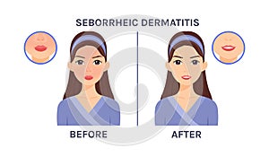 Seborrheic Dermatitis on Beautiful Face. Skin Problem. Close up of Dandruff and Redness. Treatment. Before After. Healthy Skin and