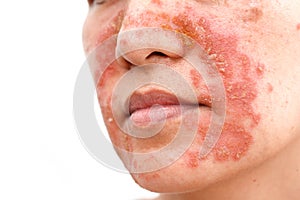 Seborrheic Dermatitis face photo