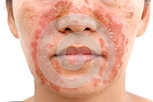 Seborrheic Dermatitis on face