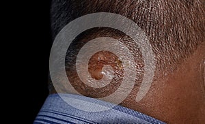 Seborrheic dermatitis at the nape of Southeast Asian, Myanmar adult male patient