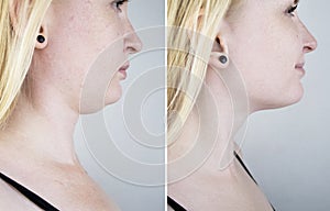 Second chin lift in women. Photos before and after plastic surgery, mentoplasty or facebuilding. Chin fat removal and face contour photo