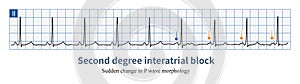 Second degree interatrial block