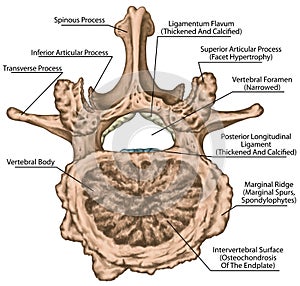 BOARD Advanced uncovertebral arthrosis of the second lumbar vertebra photo