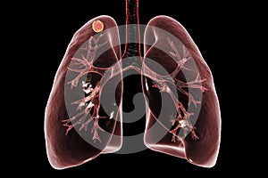 Secondary tuberculosis in lungs