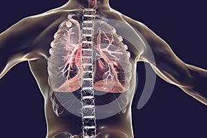 Secondary tuberculosis in lungs